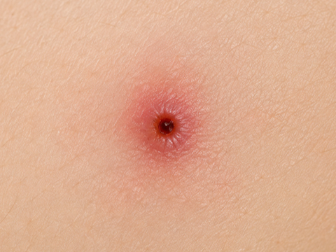 刺し傷のイメージ写真